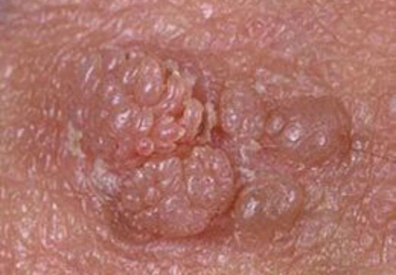 Picture of Anogenitalne bradavice