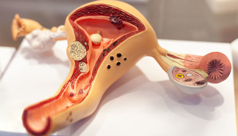 Picture of Zadebeljena sluznica maternice