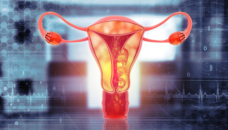 Picture of Rak maternice simptomi