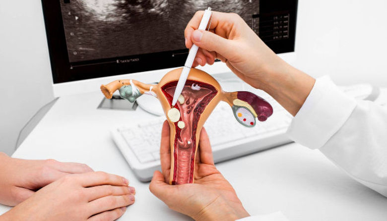 Picture of Polip na maternici