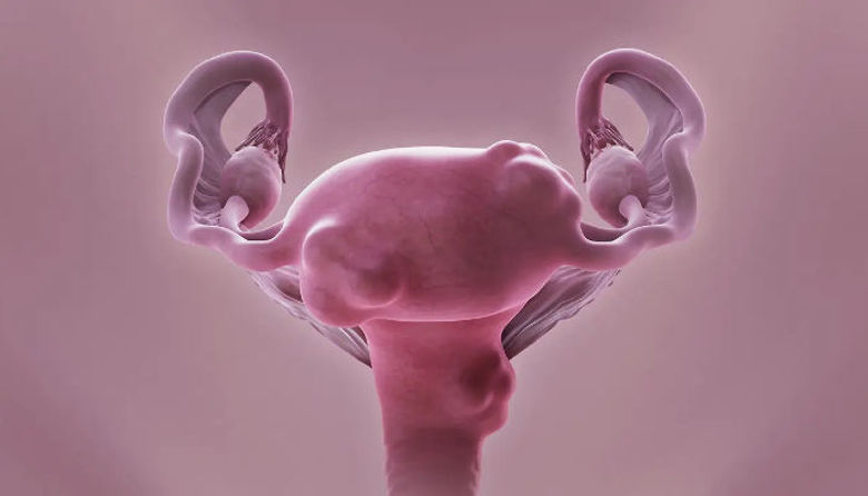 Picture of Miomi na maternici