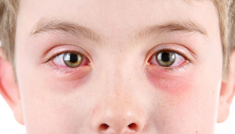 Picture of Vnetje oči pri otroku