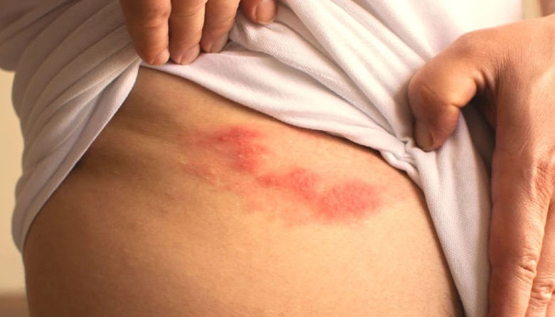 Picture of Herpes zoster trajanje