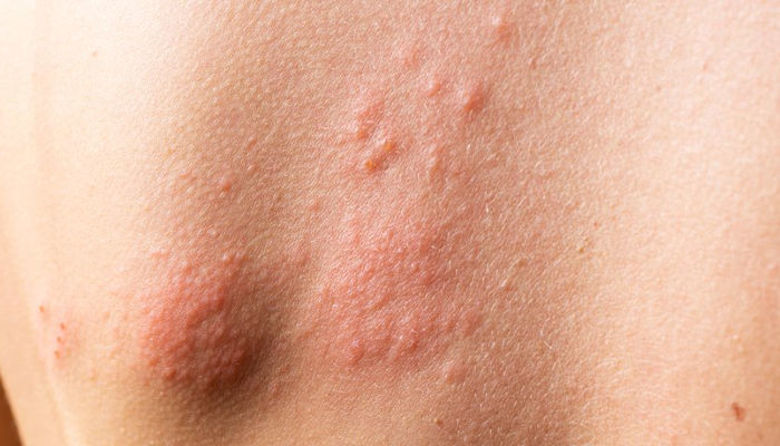 Picture of Herpes zoster Slike