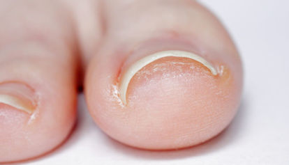 Vraščen noht domače zdravilo