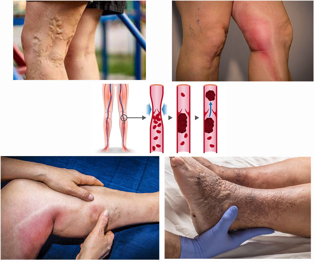 venska-tromboza-noge