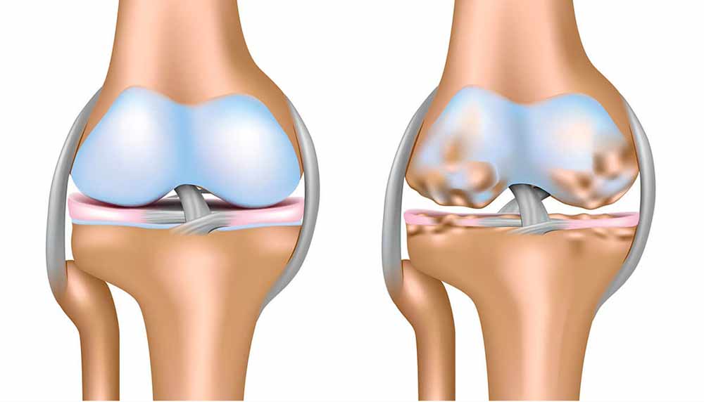 glukozamin-pharma-nord-osteoartritis